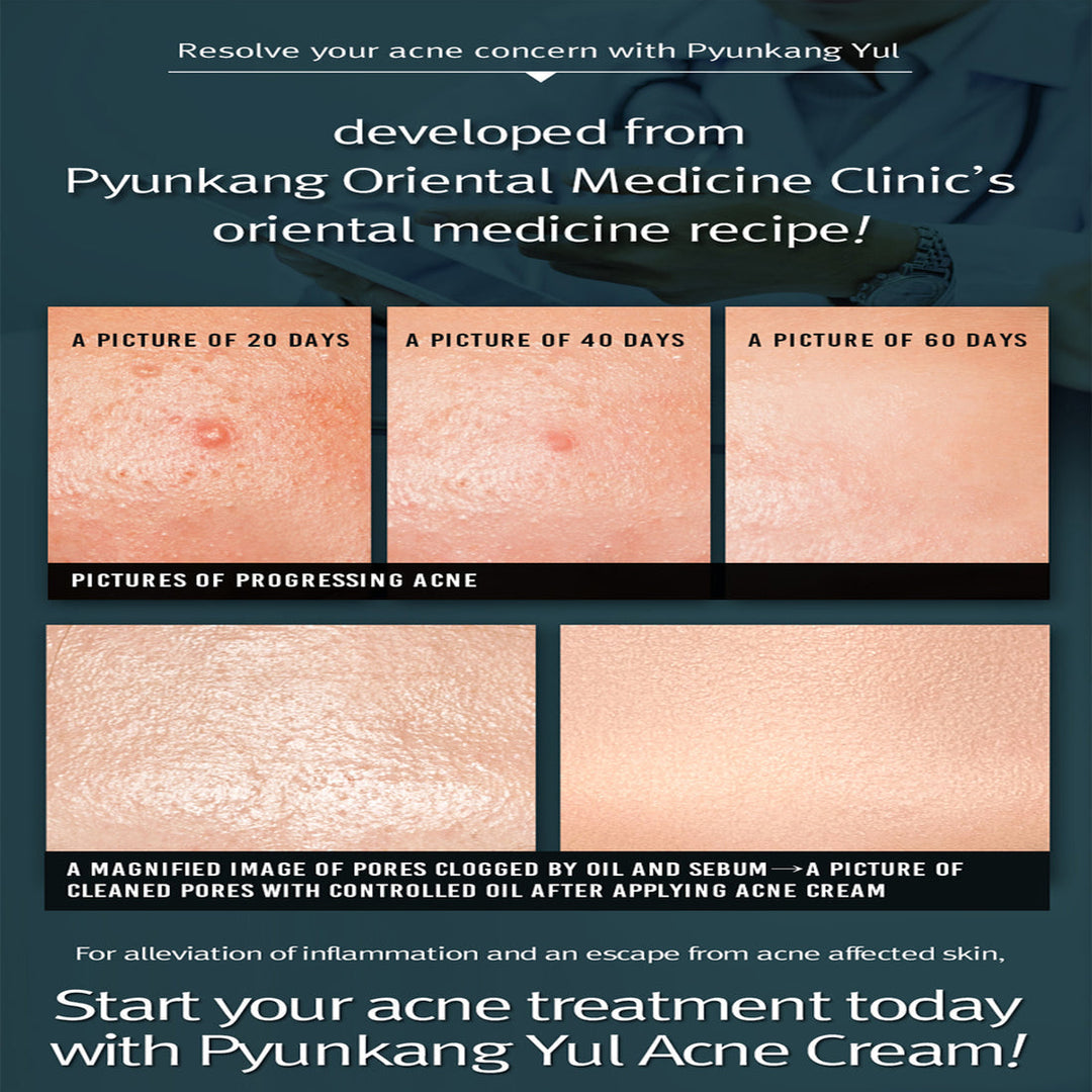 Pyunkang Yul Acne Cream  1.7 Fl. Oz,50ml